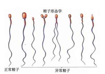 患上少精症是什么原因造成的?