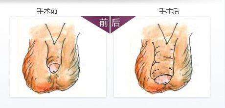 阴茎增粗