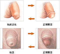 阳江割包皮会影响工作吗