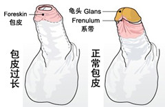 阳江专家提示男性朋友包皮过长的危害