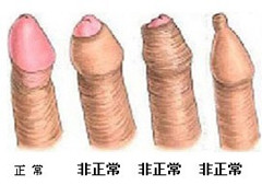 阳江割包皮哪家医院比较好