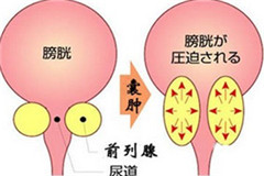 前列腺囊肿主要有哪些病因