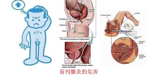 膀胱炎的预防