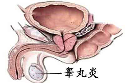 附睾炎的护理要点有哪些?