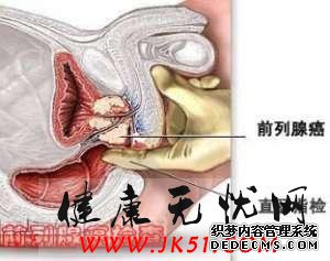  夫君的噩梦前方腺癌 预知前方腺癌的症状